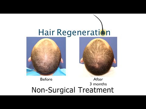 propecia hair growth