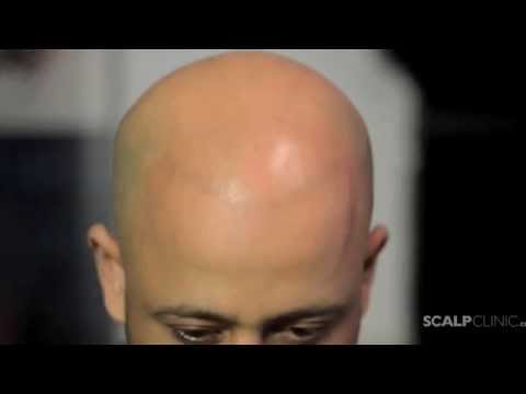 hair loss remedies for men