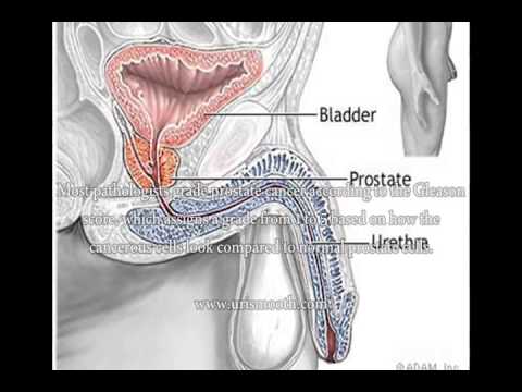 prostate enlargement