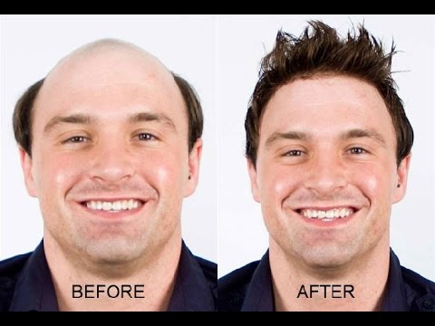 hair regrowth for men naturally