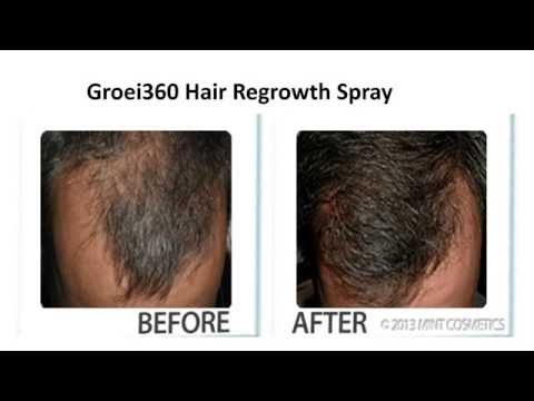 spray for hair loss