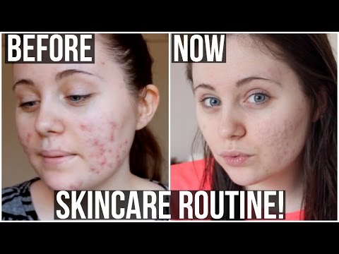 acne skin care