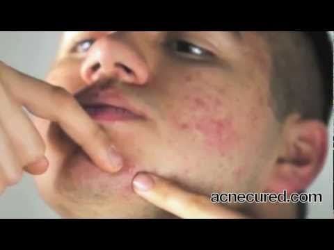 cause of acne