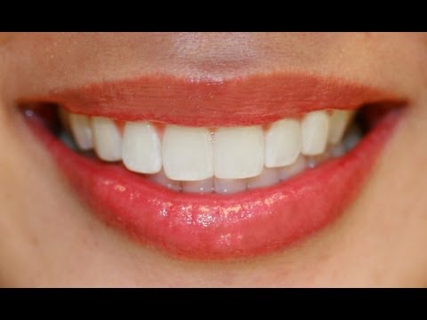 teeth whitening at home