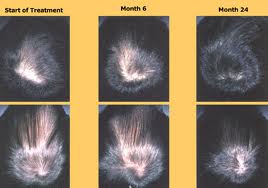 side effects of long term propecia use