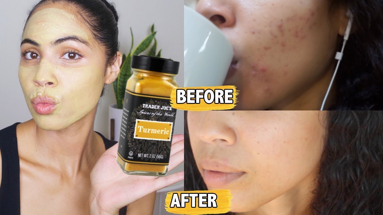 Proof That Turmeric For Acne WORKS and HOW To Use It ManHealth