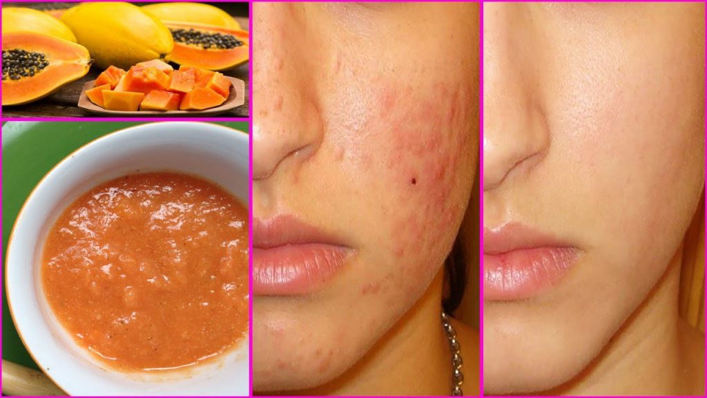 5 Natural Ways To Use Papaya For Acne Treatment