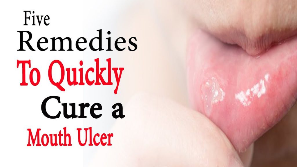 5 remedies to quickly cure a mouth ulcer Natural Health ManHealth