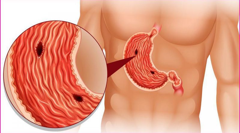 6 Ways To Relieve Stomach Ulcers At Home Natural Remedies