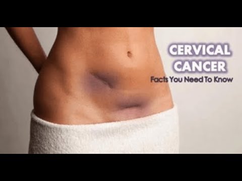 7 Signs of Cervical Cancer That Women Need to Observe