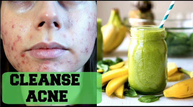 CLEAR ACNE WITH THIS GREEN SMOOTHIE|| Get rid of acne through detox/detoxifying