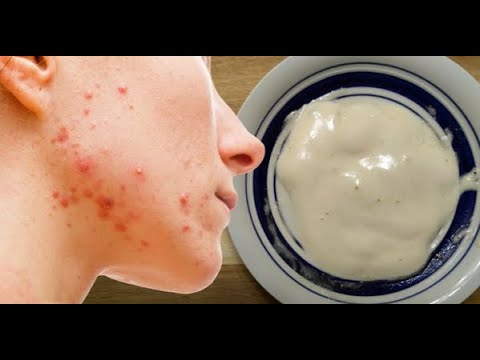 Honey, Baking Soda & Apple Cider Vinegar Mask For Acne & Radiant Skin