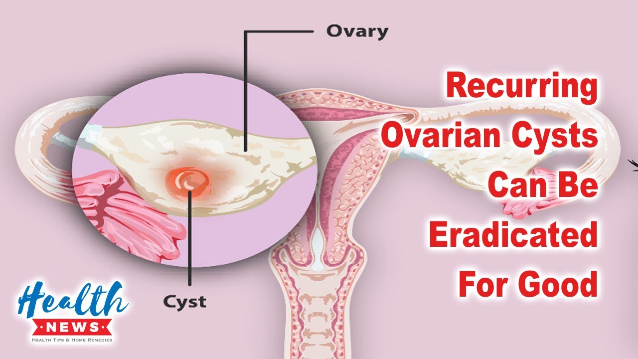 Recurring Ovarian Cysts Can Be Eradicated For Good ManHealth