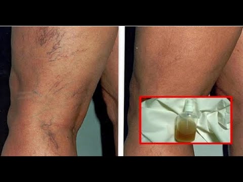 Successfully Treat Capillaries And Veins With These 4 Herbal Recipes