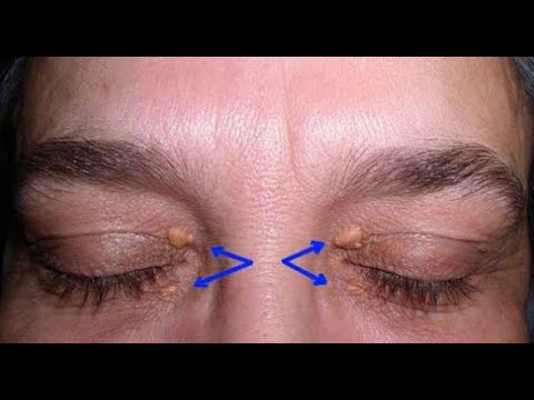 Warning Signs of a Heart Attack Can be Found on Your Eyelids