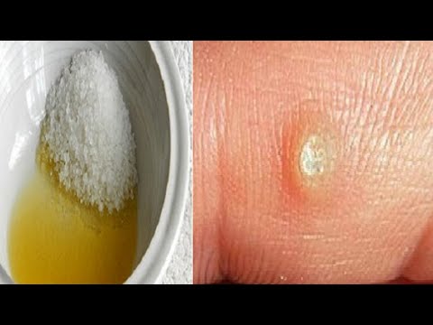 With This Mixture For 10 Days Only, You Can Remove The Toughest Wart!