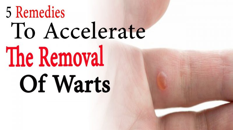 5 Remedies To Accelerate The Removal Of Warts | Natural Health