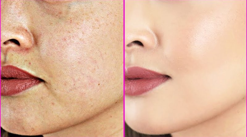 6 Natural Ways To Treat Dark Spots Known As Hyperpigmentation