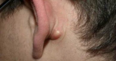 A Lump Behind Your Ear - DO YOU HAVE IT: THIS RIDGE BEHIND THE EAR IS A SIGN OF SOMETHING DANGEROUS!