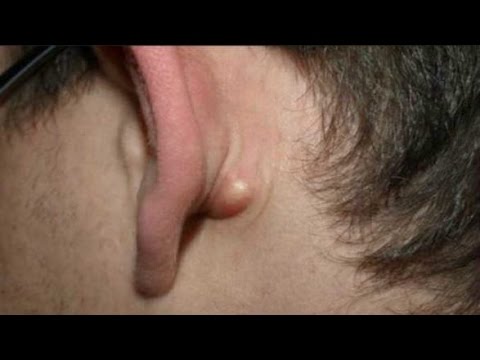 A Lump Behind Your Ear - DO YOU HAVE IT: THIS RIDGE BEHIND THE EAR IS A SIGN OF SOMETHING DANGEROUS!