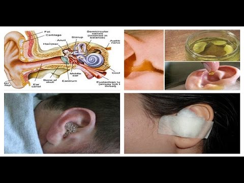 Say Goodbye To Ear Infection! Cure Ear infection In Just 1 Day 100% Naturally