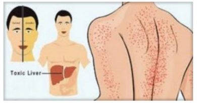 Signs of Liver Damage - 13 SYMPTOMS OF A DAMAGED LIVER!