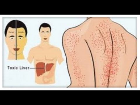 Signs of Liver Damage - 13 SYMPTOMS OF A DAMAGED LIVER!