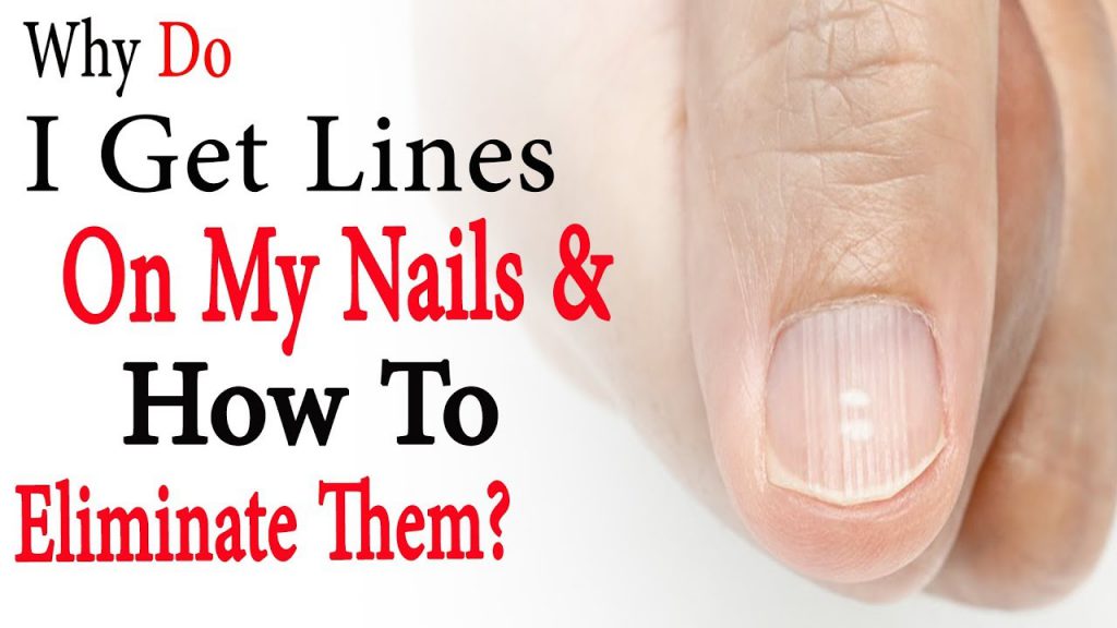 Why do I get lines on my nails and how to eliminate them | Natural ...