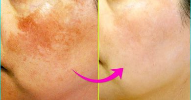5 Simple Home Remedies To Treat Skin Pigmentation Naturally