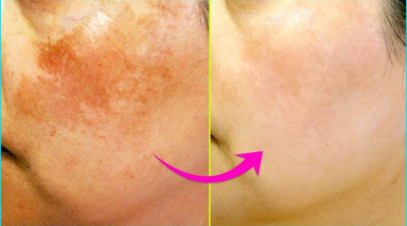 5 Simple Home Remedies To Treat Skin Pigmentation Naturally