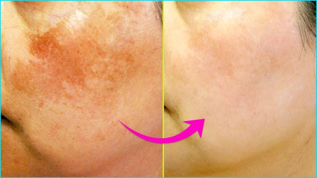 5 Simple Home Remedies To Treat Skin Pigmentation Naturally Man