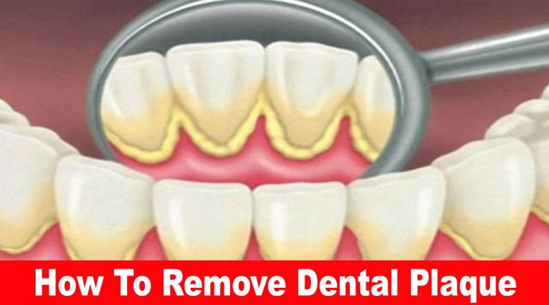 How To Remove Dental Plaque In 5 Minutes Naturally