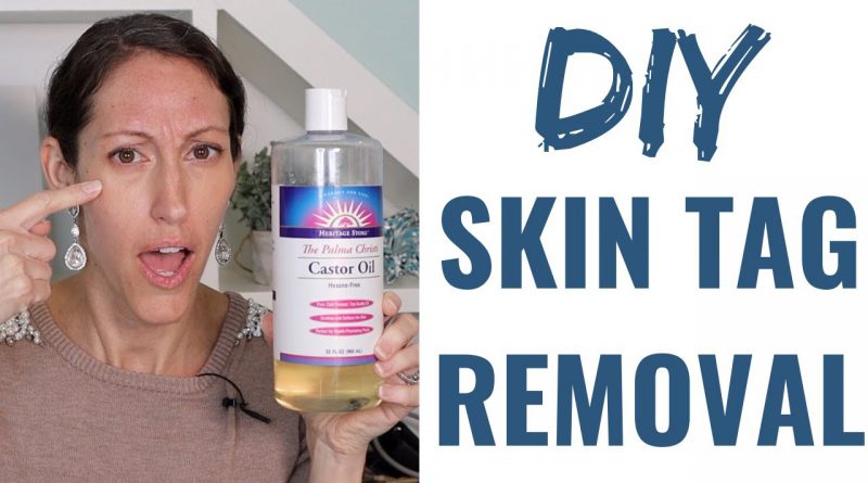 How to Get Rid of a Skin Tag | Natural Skin Tag Removal Home Remedies & Tips