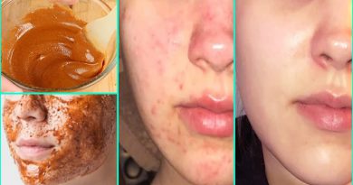 The Complete Guide Of Use Honey And Cinnamon For Acne