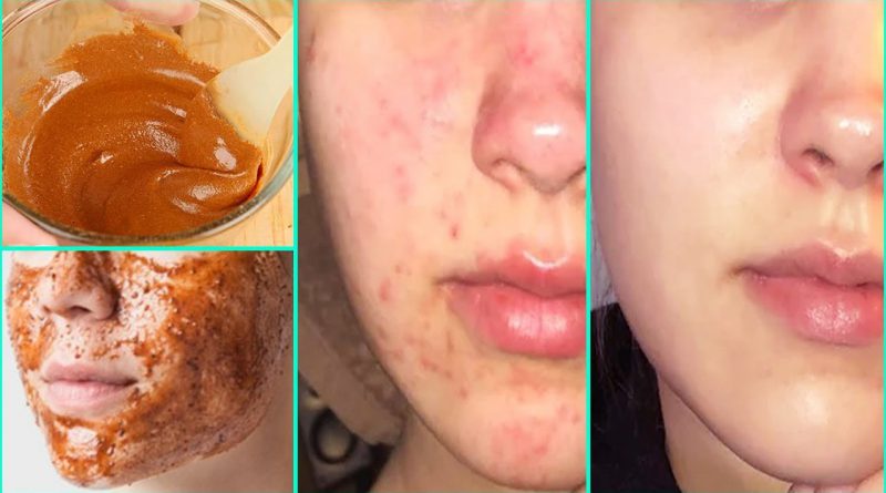 The Complete Guide Of Use Honey And Cinnamon For Acne