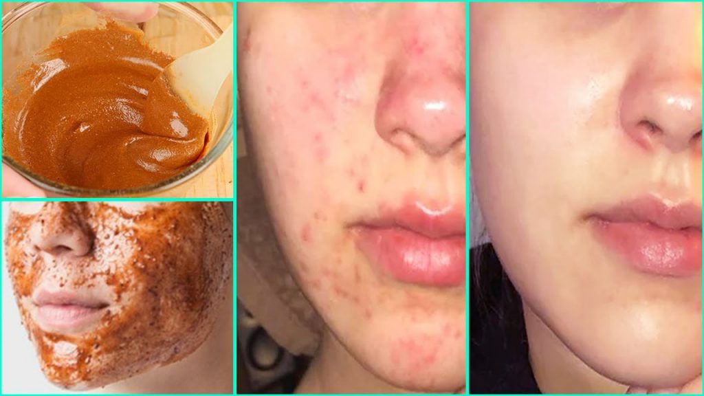 The Complete Guide Of Use Honey And Cinnamon For Acne