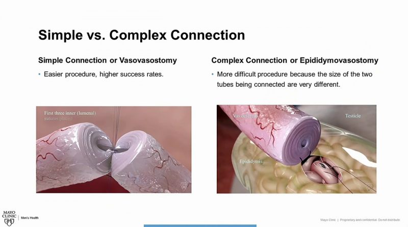 Men's Health Moment: Vasectomy Reversal: Overview