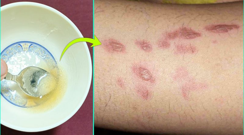 How To Remove Burn Marks And Scars From Skin | Best Home Remedy For Burn Marks