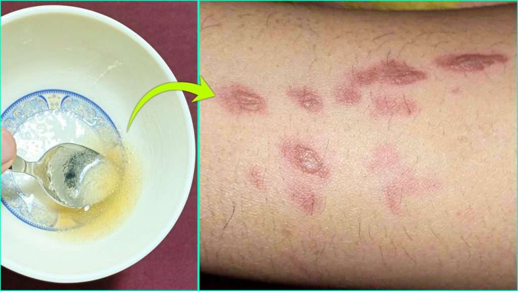 How To Remove Burn Marks And Scars From Skin | Best Home Remedy For