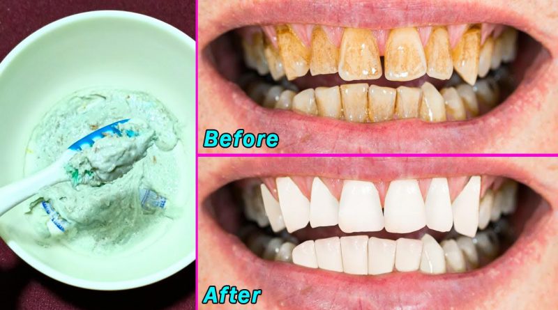 Magical Teeth Whitening Remedy, Get White And Shiny Teeth Like Pearls In Just 3 Minutes At Home