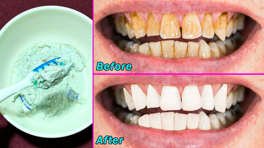 Magical Teeth Whitening Remedy, Get White And Shiny Teeth Like Pearls ...