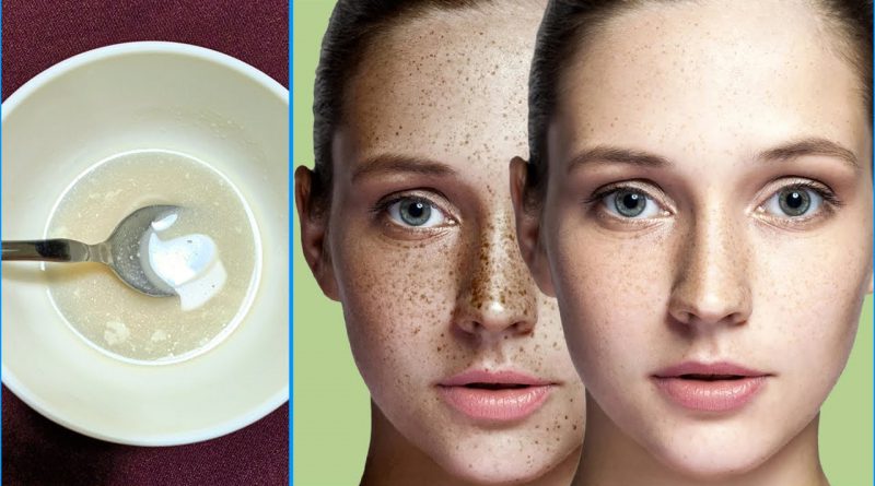How To Get Rid Of Freckles And Dark Spots On The Face, Freckles Removal Home Remedy