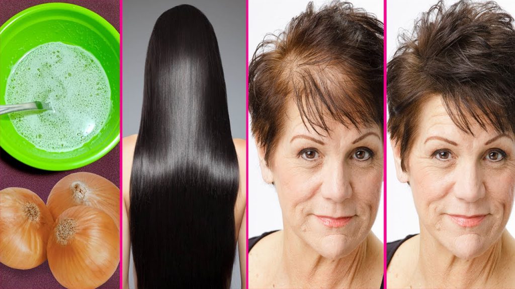 How To Grow Long Thick Hair With Onion Juice, Hair Regrowth Using Onion