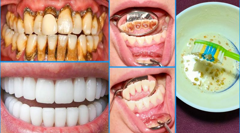 In Just 5 Minutes, White Teeth Whiten And Shiny Like Pearls, Magic Teeth Whitening Remedy