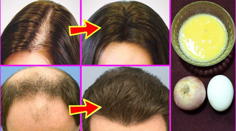 Onion Juice And Egg Mask For Hair Growth And Thickness / Onion Juice For Hair Growth