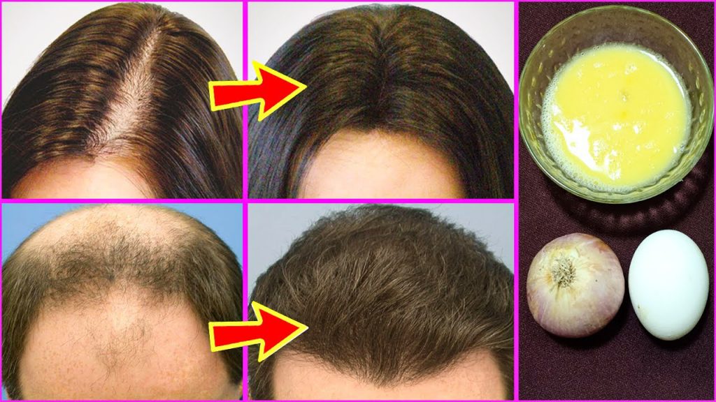 Onion Juice And Egg Mask For Hair Growth And Thickness / Onion Juice ...