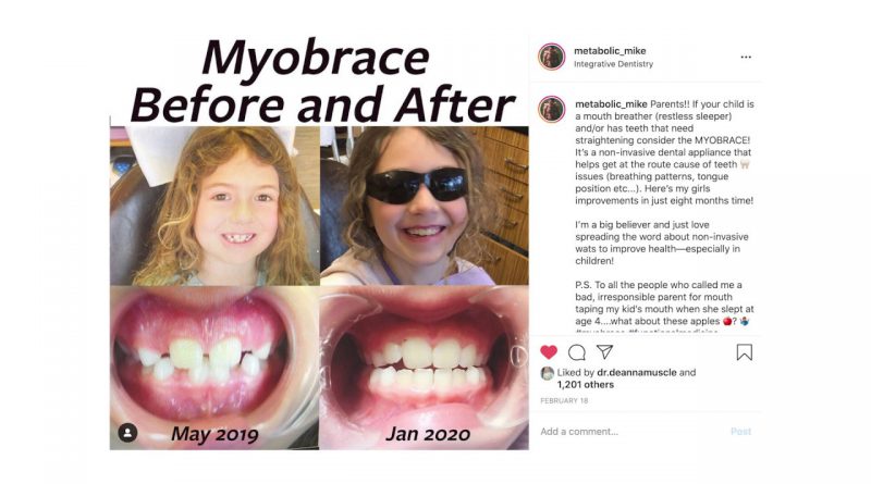 Tool to Stop Mouth Breathing Actually Changed my Kids' Face: MYOBRACE review