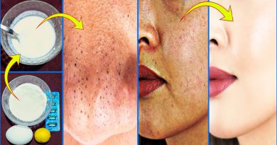 Get Rid Of Blackheads, Dark Spots, Close Large Open Pores, Natural Remedy 100% Results