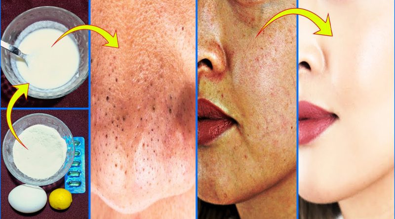 Get Rid Of Blackheads, Dark Spots, Close Large Open Pores, Natural Remedy 100% Results