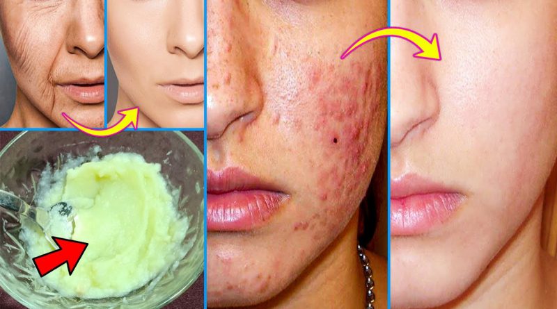 Homemade Secret Face Pack - Remove Acne And Acne Scars - Tightening Skin You Look Younger